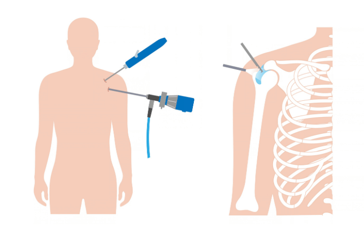Shoulder Arthroscopy