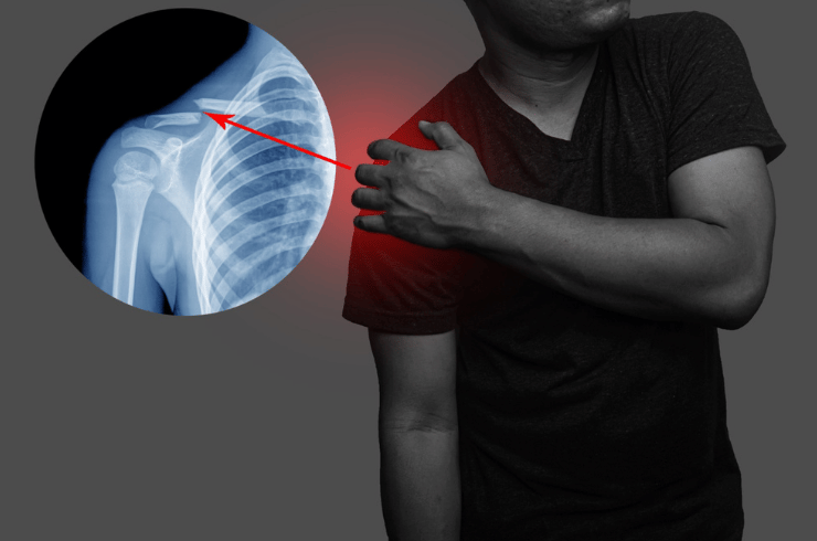 Shoulder Joint Replacement